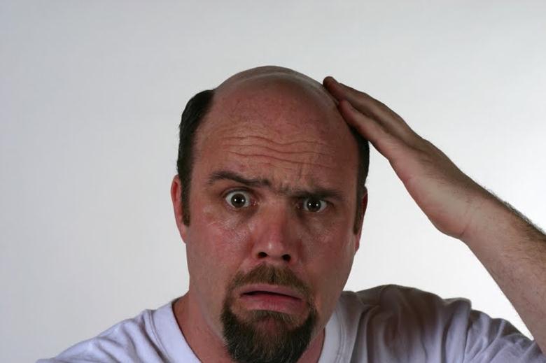 Выпадение волос из-за повышенного количества мужских гормонов