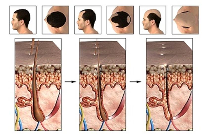 Стадии облысения